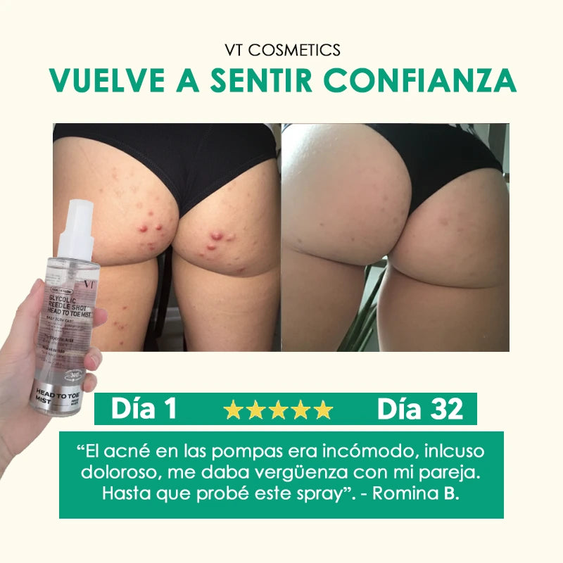 Spray con ácido glicólico y niacinamida para eliminar acné en glúteos y manchas oscuras